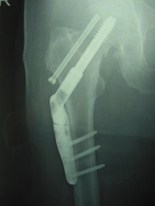 大腿骨転子部骨折に対する骨接合術